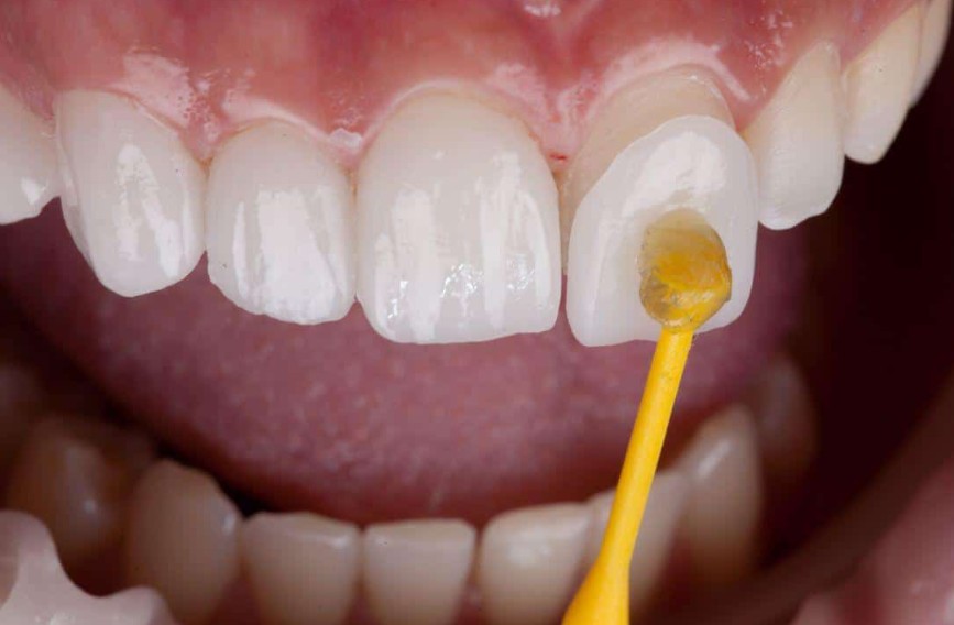 5 Worst Habits for Veneered Teeth